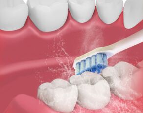 Gingivitis – was genau ist das eigentlich?